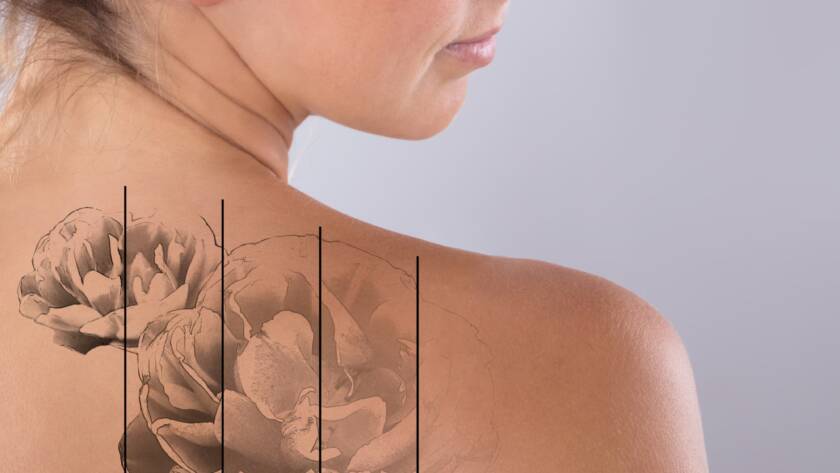 Tattoo removal treatment consultation at Visage New York Manhattan NYC