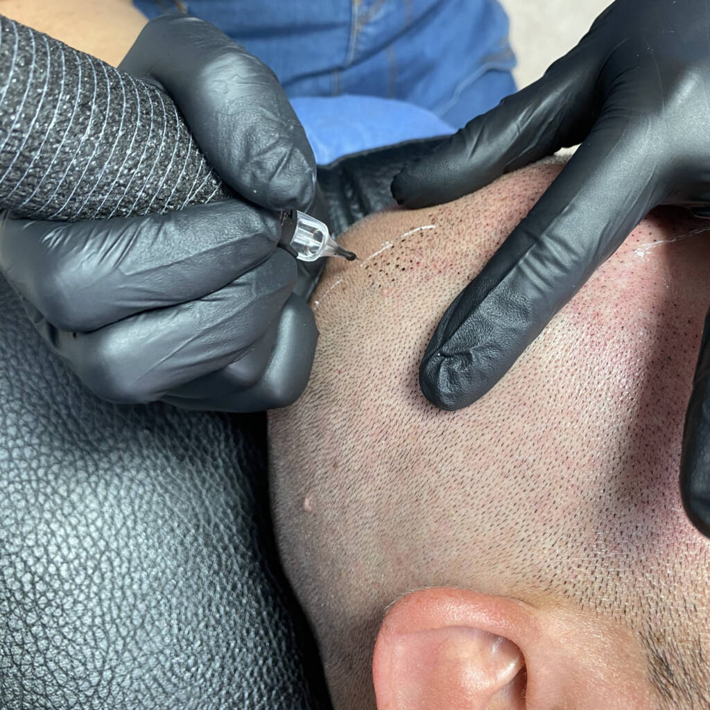 Performing hair micropigmentation procedure First session_edited