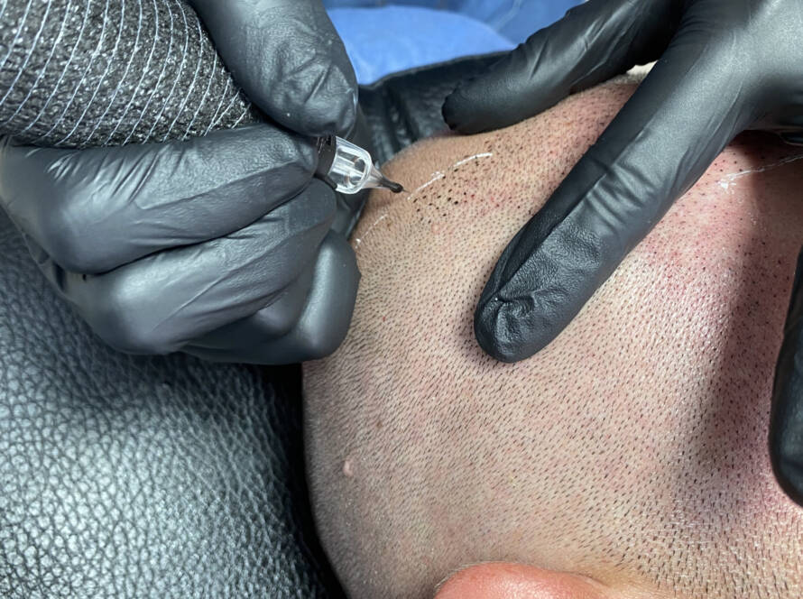 Performing hair micropigmentation procedure First session_edited