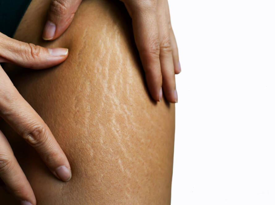 Scar Camouflage In New York