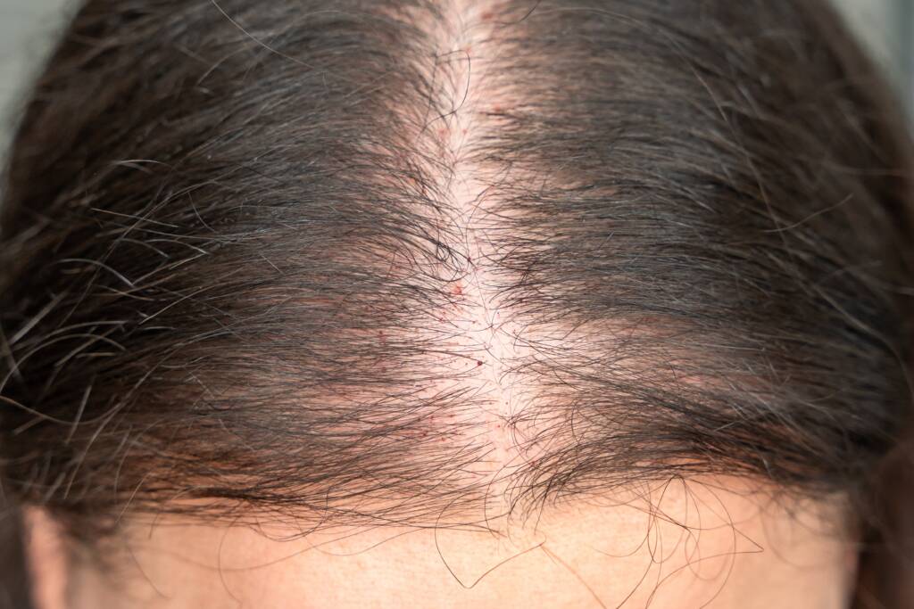 Hair Regrow Microneedling