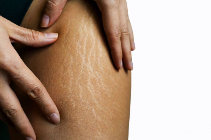 Stretch Mark Revision