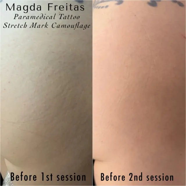 If you’ve ever felt self-conscious about stretch marks, you deserve a solution that looks refined—not dramatic—and feels genuinely considered. In our latest piece on Stretch Mark Camouflage Tattoo NYC results, we break down what “camouflage” really means, how precise matching and careful technique shape natural coverage, and what to expect when your design is created around your skin. Visage New York pairs advanced, paramedical expertise with a spotless, protocol-driven Midtown studio—so you can feel like yourself, only more confidently.

https://www.visagenewyorkstudio.com/stretch-mark-camouflage-tattoo-nyc/
•
•
#scarcamouflage #stretchmarks #camouflage #paramedicaltattoo #visagenewyork